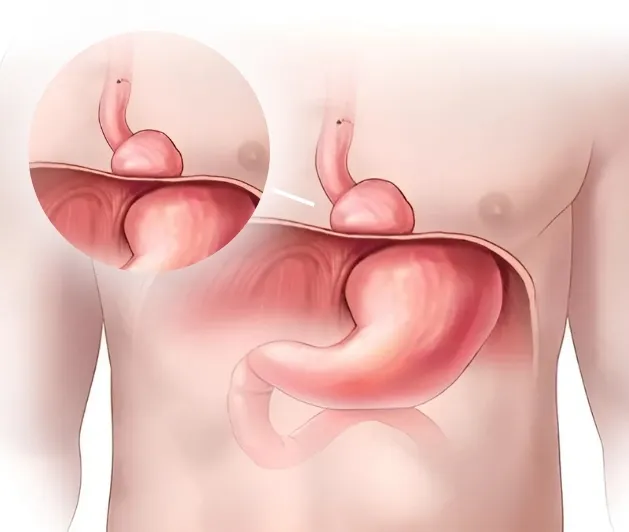 hiatal hernia